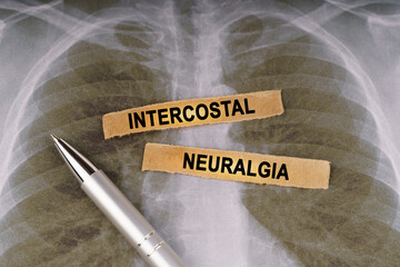 On a human chest x-ray, a pen and strips of paper labeled - intercostal neuralgia