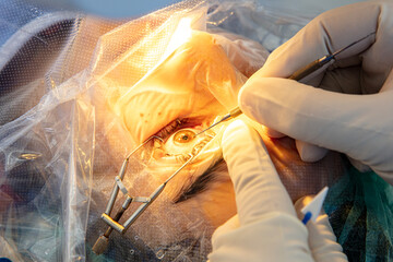 Eye surgery process, treatment of cataract and diopter correction. Surgical implementation of...