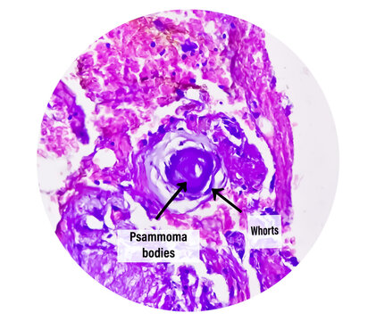 Psammoma Bodies. Spinal Tumor Biopsy. Psammomatous Meningioma.