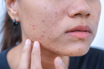 Close up of young Asian woman worry about her face when she has problems with skin on her face....