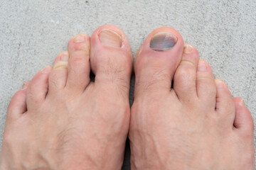 toe nail bruise hemtoma. subungal toe nail bruise hemtoma.