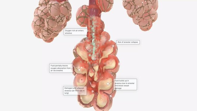 COVID-19, Acute Respiratory Distress Syndrome