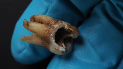 Tooth decay and dentist hand with glove and black background. Macro shot of a decayed teeth till root after extraction of dentist. Real tooth anatomy due lack of dental care. Top view of caries teeth