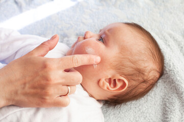 Baby with atopic dermatitis getting cream put. Care and Prevention Of Eczema.