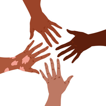 Group of hands reaching to each other, one hand with vitiligo patch