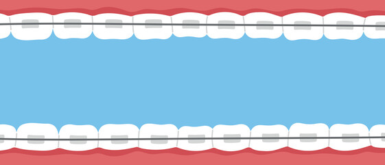 Teeth braces banner. Orthodontic problem, smile with brackets, retainer. Flat vector isolated illustration