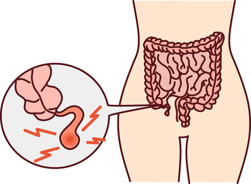 Human body with inflamed appendicitis