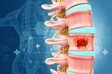 Spine cancer or spinal tumor disease. 3d illustration