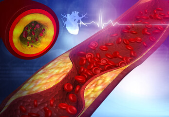 Artery blocked with bad cholesterol. clogged arteries, coronary artery plaque. 3d illustration