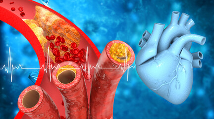 Clogged arteries, coronary artery plaque with human heart. 3d illustration.
