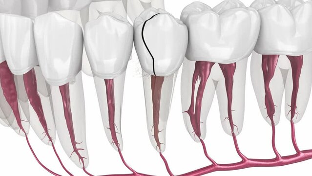 Cracked tooth, splitted. Medically accurate 3D animation