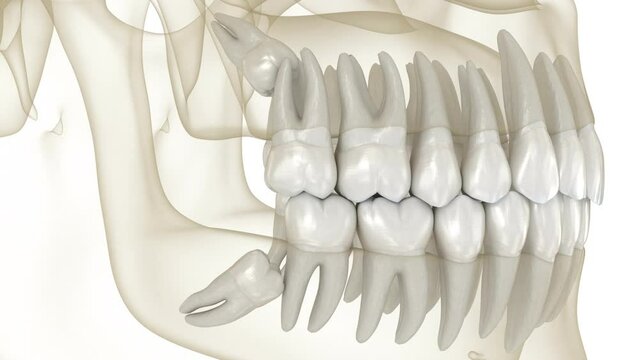 Mesial impaction of Wisdom teeth to the second molar. Medically accurate tooth 3d animation
