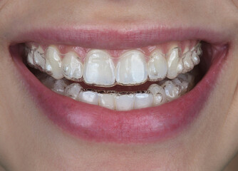 Female model mouth in close showing transparent orthodontic aligner