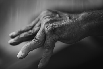 Black and White Elderly Hand with Arthritis - Finger and Wrist Joint Pain