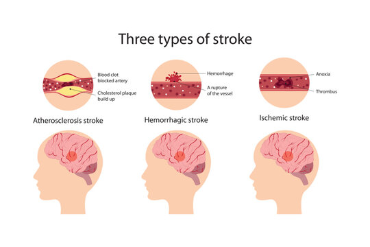 Three types of stroke. Atherosclerosis, hemorrhagic and ischemic stroke