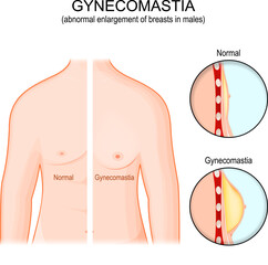 Gynecomastia. Torso of healthy man and abnormal enlargement of breasts in male