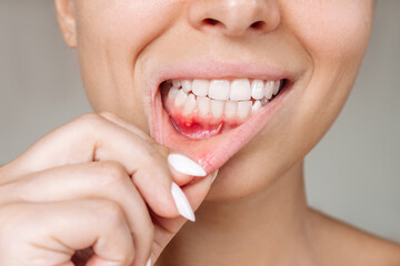 Ulcerative stomatitis on the gums. Gum inflammation. Cropped shot of a young woman showing red...