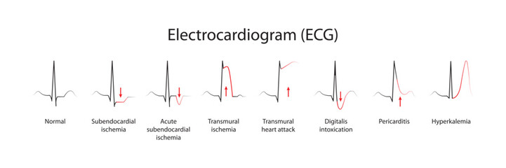 Interpretation of the electrocardiogram (ECG) - obrazy, fototapety, plakaty