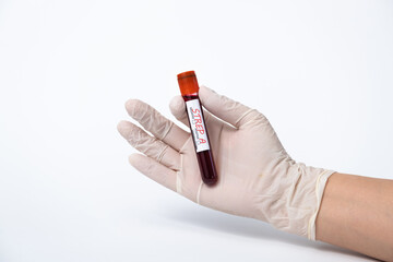 Blood collection tubes Group A Streptococcus test. strep A epidemic.