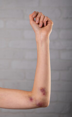 Big bruise on the girl's skin close up