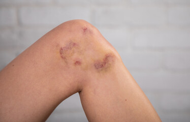 Close up of stain bruise wound on leg, contusion young woman, girl on joint knee from an accident fell down, hand in healing injury by massage hematoma blood