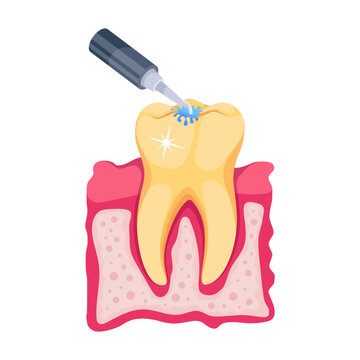 Root Canal