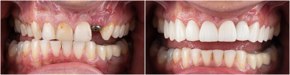 emax ceramic crowns and veneers