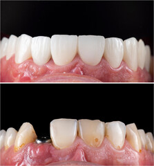 emax ceramic crowns and veneers