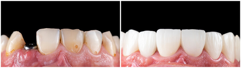 emax ceramic crowns and veneers