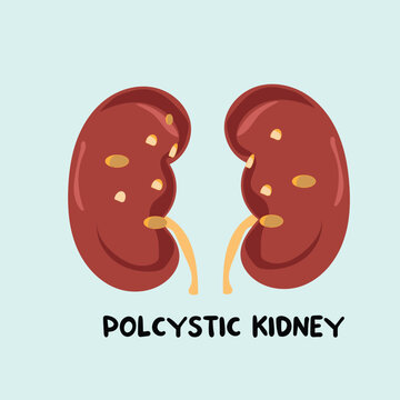 kidney polcystic vector illustration 
