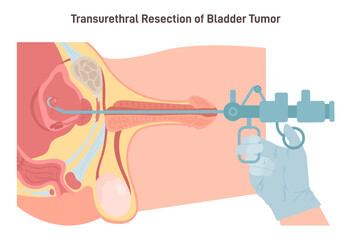 Transurethral resection of the bladder tumor. Male bladder benign - obrazy, fototapety, plakaty