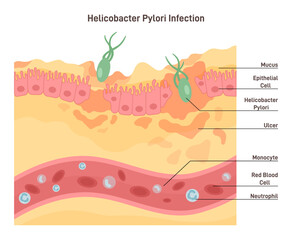 Helicobacter pylori infection. Bacterium with flagella damage the tissue