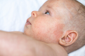 a baby boy face with red irritated marks near left ear and cheek, atopic dermatitis, blisters on sensitive skin in focus, a child laying on a white cloth with inflamed skin on his face, head, forehead