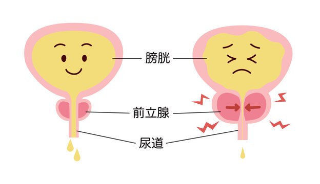 正常と前立腺肥大の比較説明イラスト