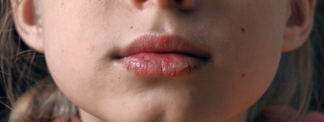 Chapped lips of a teenager boy close-up.The concept of diathesis and children's skin health.Health...