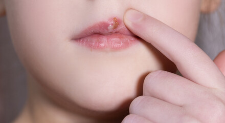 Children's herpes virus on the lip of a sick girl. The child points a finger at the wound on the upper lip. Close-up of the disease