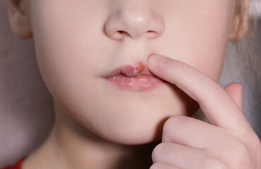 Fototapeta premium Children's herpes virus on the lip of a sick girl. The child points a finger at the wound on the upper lip. Close-up of the disease