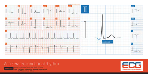 Ectopic beats originate from the atrioventricular junctional region. The PR interval  is usually less than 120ms, the P-wave is inverted, and the QRS waveform is supraventricular pattern.