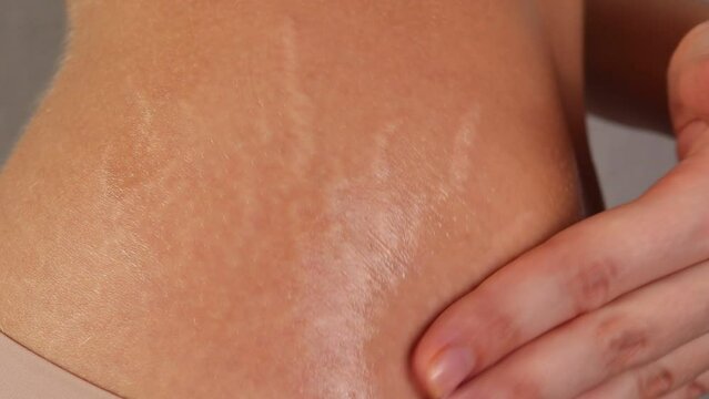 Stretch marks on a womans hips. Cream for skin stretching