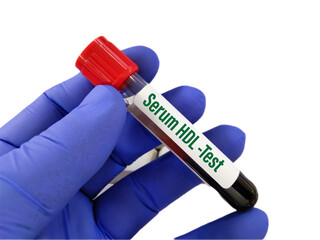 Blood sample for Lipid profile, Triglyceride, HDL and LDL test. Copy space on white background - obrazy, fototapety, plakaty