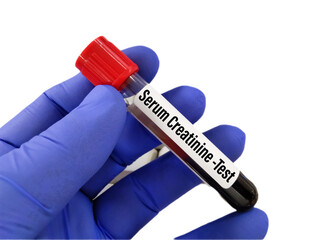 Blood sample for Serum Creatinine and Urea test. Copy space on colour background - obrazy, fototapety, plakaty