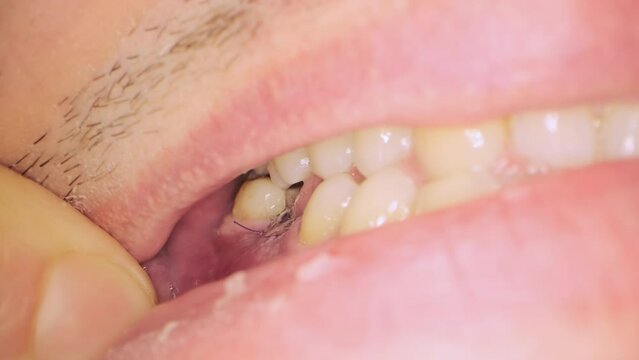 Man tries to open mouth wide to show black threads put on gum after implant placement. Teeth treatment in dental clinic extreme closeup