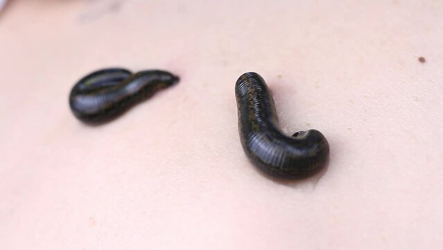 Selective focus on one of the leeches. the leech sucks blood from the skin . bloodletting procedure