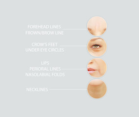 Effects of ageing,Frownscowl lines ,Nasolabial folds,Neck ,Under eye circles,neck lines. Plastic...