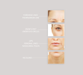 Effects of ageing,Frownscowl lines ,Nasolabial folds,Neck ,Under eye circles,neck lines. Plastic...