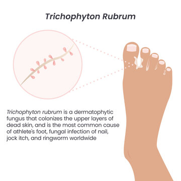Trichophyton Bilder Durchsuchen 1,165 Archivfotos, und