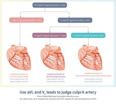 When the ST segment of leads I and aVL is elevated, the culprit vessels can be the left anterior descending artery, the obtuse marginal artery, and the diagonal artery.