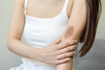 Fototapeta na wymiar Close up of stain bruise wound on her arm, contusion asian young woman, girl an accident fell down stairs at home, hand in healing injury by massage hematoma blood. Extravasation blue, purple on skin.