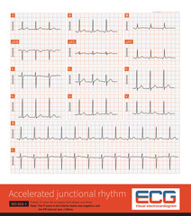 The retrograde P wave of the inferior leads can come from the lower part of the atrium, the lower part of the atrial septum, and the atrioventricular junctional region. 