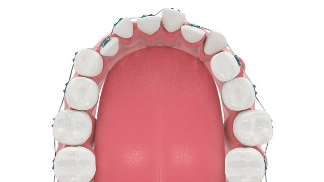 Teeth alignment by orthodontic braces isolated over white background
